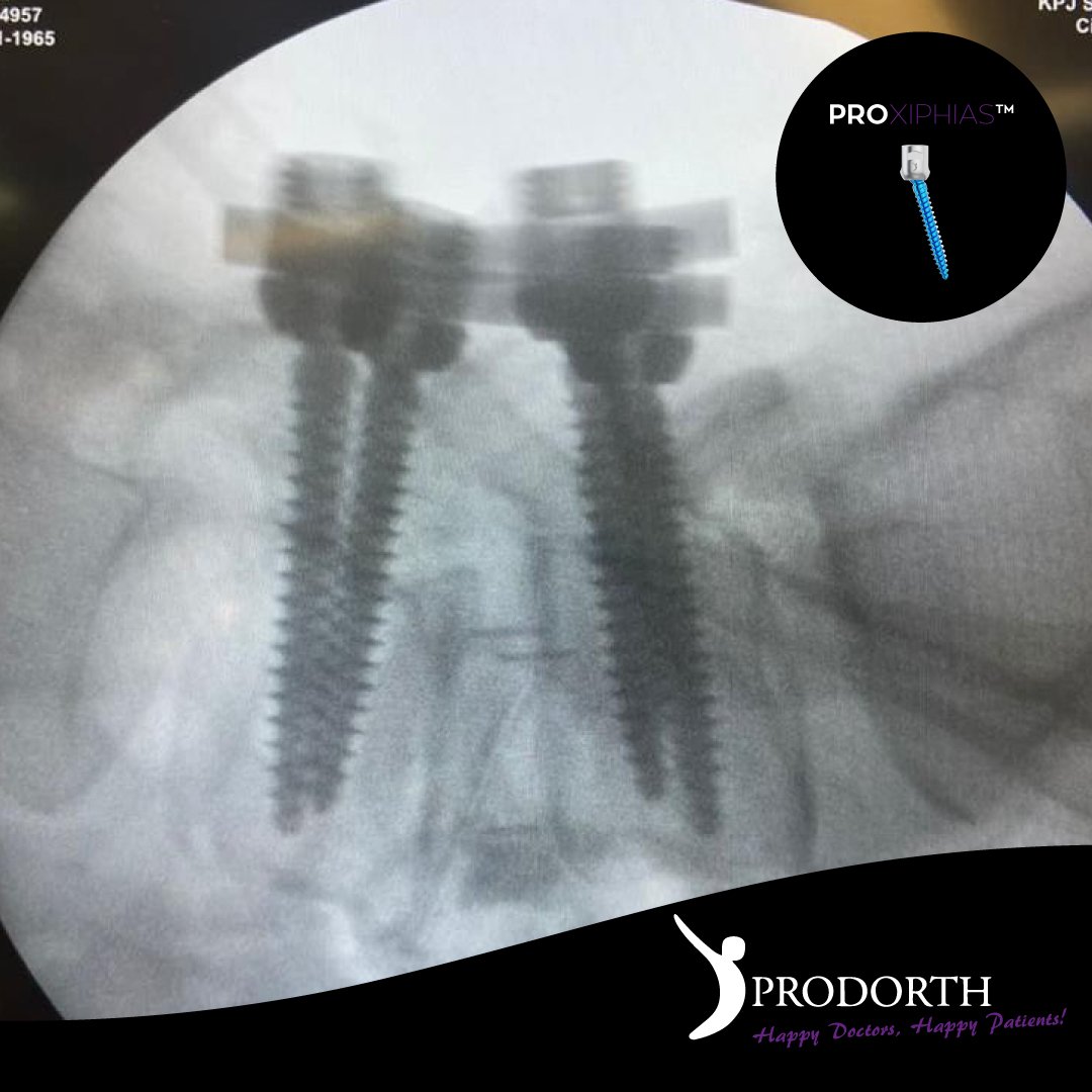 prodorth_spine's tweet photo. 🎯 Posterior Fixation Systems

PROXIPHIAS™️

📍 Malaysia

https://t.co/xoMd5o4TE3

#prodorthspine #spinehealth #spinesurgery #spinedoctor #spinedevice #spineimplants #surgeryinstruments #spinesurgeryinstruments #orthopedicsurgery #thoracolumbarfusion #PedicleScrews https://t.co/7QXOPPa3o9