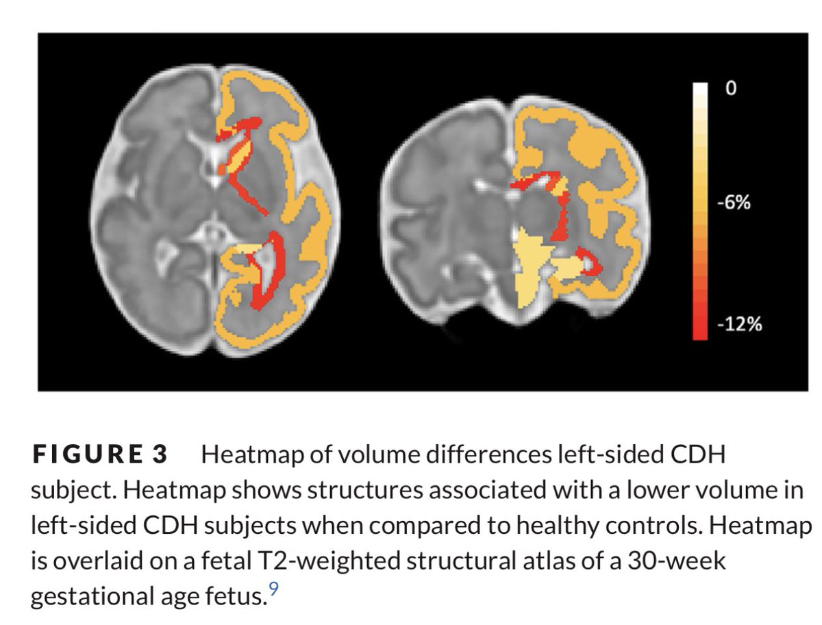 Pediatric Imaging Research Center (@pirc_mgh) on Twitter photo New work on fetal brain development in Congenital diaphragmatic hernia from MGH PIRC <a href="/Camilojaimesc/">Camilo Jaimes</a> <a href="/fmachadorivas/">Fedel Machado Rivas</a>, <a href="/boschildrensrad/">Boston Children's Radiology</a> <a href="/bedoya3aleja/">Alejandra Bedoya, MD</a> <a href="/OnurAfacanMRI/">Onur Afacan</a> <a href="/SimonWarfield/">Simon Warfield</a> and John Choi from <a href="/CincyKidsRad/">Cincy Kids Radiology</a> New work on fetal brain development in Congenital diaphragmatic hernia from MGH PIRC <a href="/Camilojaimesc/">Camilo Jaimes</a> <a href="/fmachadorivas/">Fedel Machado Rivas</a>, <a href="/boschildrensrad/">Boston Children's Radiology</a> <a href="/bedoya3aleja/">Alejandra Bedoya, MD</a> <a href="/OnurAfacanMRI/">Onur Afacan</a> <a href="/SimonWarfield/">Simon Warfield</a> and John Choi from <a href="/CincyKidsRad/">Cincy Kids Radiology</a>