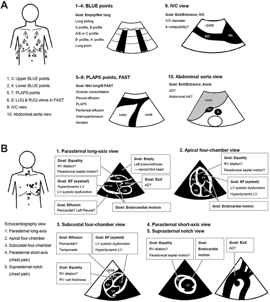 Syed Shahrul Naz (@drshahrul80) on Twitter photo “SEARCH 8Es: A novel point of care ultrasound protocol for patients with chest pain, dyspnea or symptomatic hypotension in the emergency department.”
#FOAMed #POCUS #FOAMus #FOAMcc #MedEd #CriticalCareUltrasound #IntensiveCare #CriticalCare #MedTwitter 🔗 journals.plos.org/plosone/articl… “SEARCH 8Es: A novel point of care ultrasound protocol for patients with chest pain, dyspnea or symptomatic hypotension in the emergency department.”
#FOAMed #POCUS #FOAMus #FOAMcc #MedEd #CriticalCareUltrasound #IntensiveCare #CriticalCare #MedTwitter 🔗 journals.plos.org/plosone/articl…