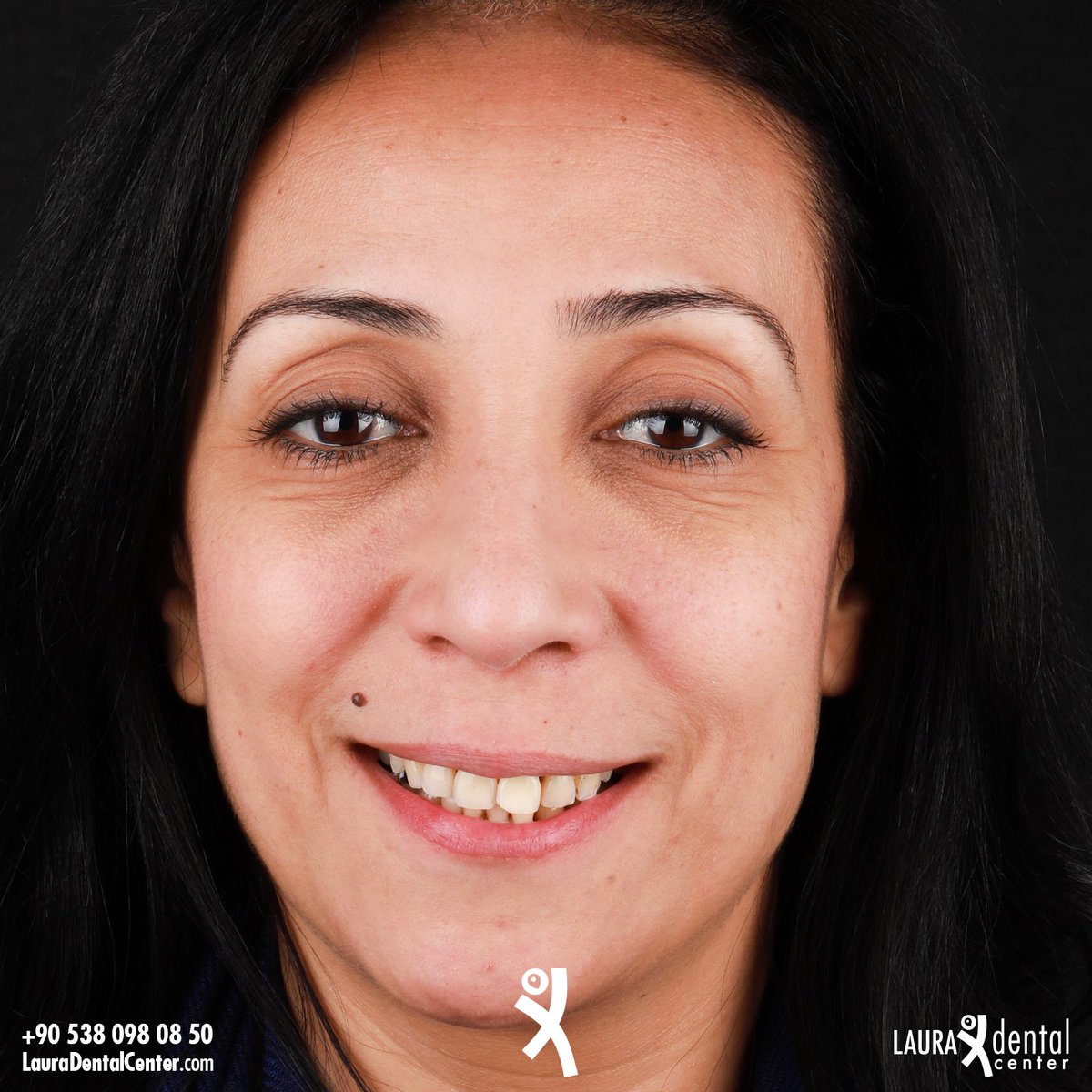 LauraDentalC's tweet photo. ๐ฌ๐ง Your smile is a symbol of your self-confidence. Don't hide your smile with beautiful teeth! The right address for beautiful teeth is Laura Dental Center.
#LauraDentalCenter
#SmileDesignTurkey #Implant #AllonSix #InstaTeeth #CosmeticDentistry #TeethWhitening #Antalya https://t.co/exOhRqVVMx