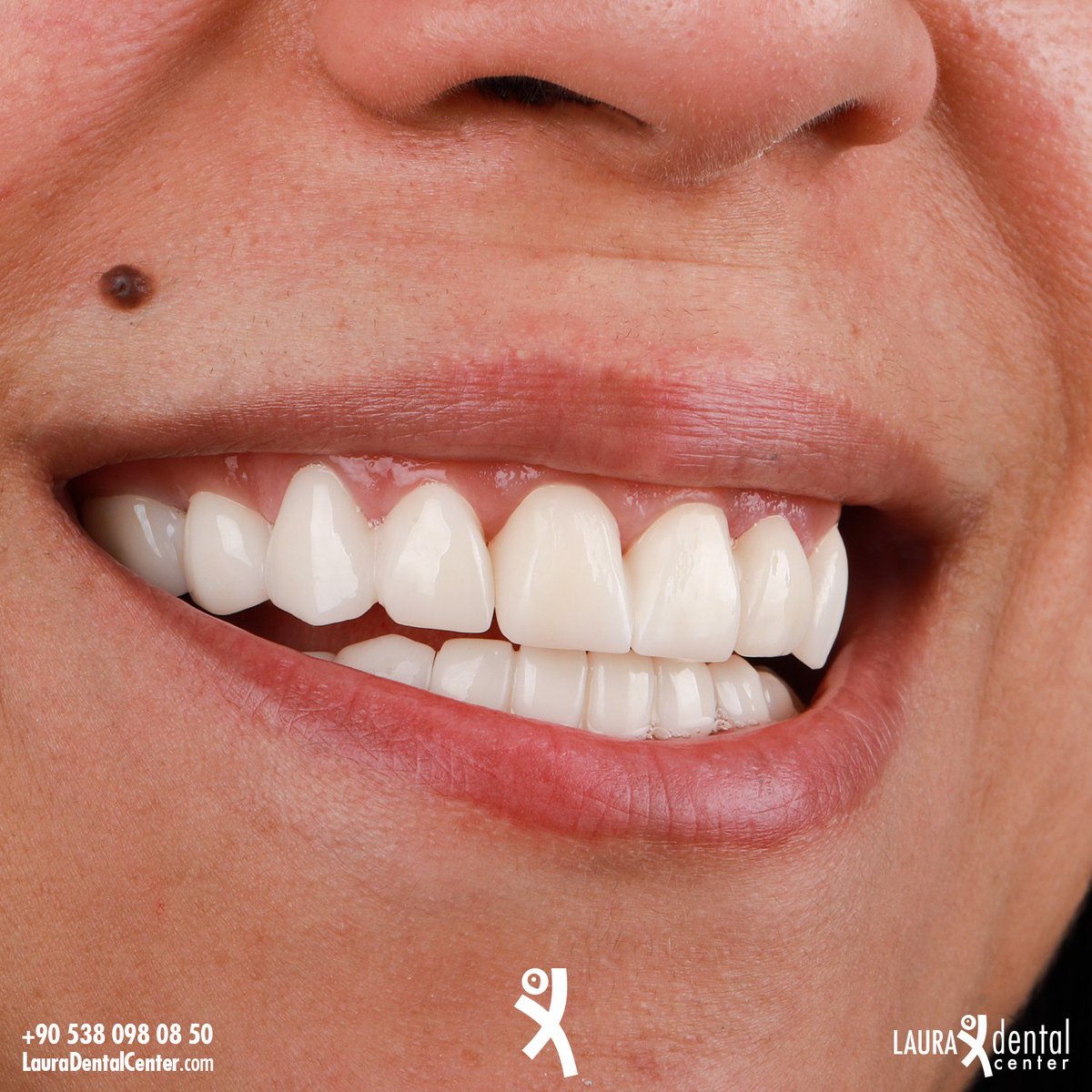 LauraDentalC's tweet photo. ๐ฌ๐ง Your smile is a symbol of your self-confidence. Don't hide your smile with beautiful teeth! The right address for beautiful teeth is Laura Dental Center.
#LauraDentalCenter
#SmileDesignTurkey #Implant #AllonSix #InstaTeeth #CosmeticDentistry #TeethWhitening #Antalya https://t.co/exOhRqVVMx