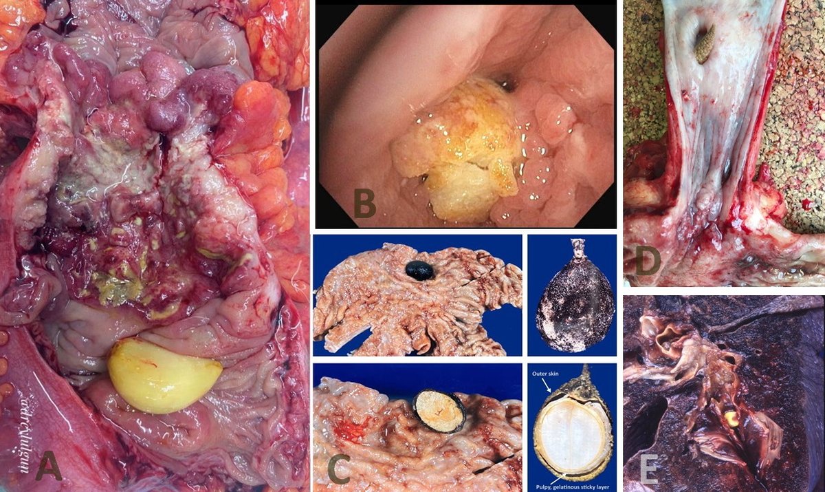 Veggies and fruit- From Atlas of Medical Foreign Bodies (flickr.com/photos/foreign…) A- Garlic clove adjacent to colonic adenoca. B- Aspirated cauliflower- bronchus C- Genip (kenep, etc) fruit - stomach D- Baby corn in esophageal diverticulum E- Aspirated corn kernel-lung/bronchus