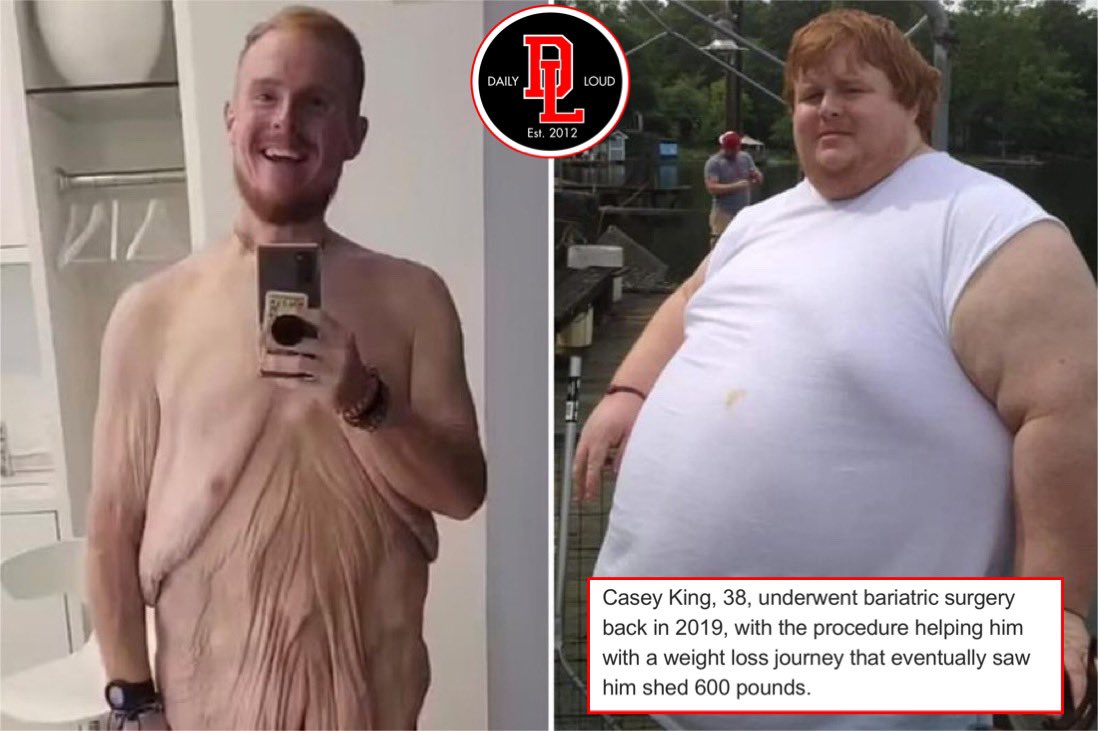 Obese reality star Casey King loses 600 pounds in life-changing transformation 🙏