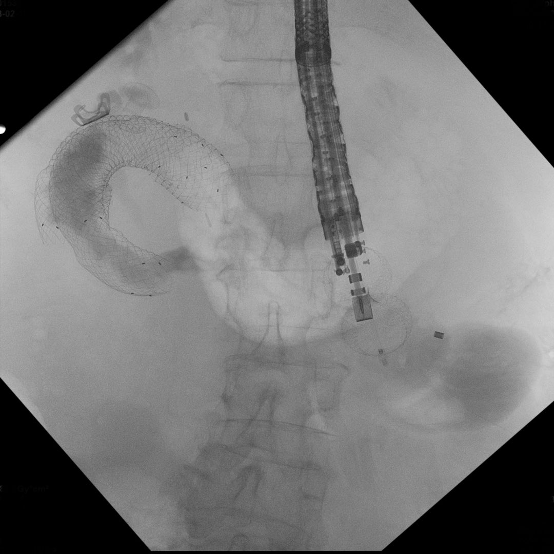 AymericBecq's tweet photo. A successful first EE gastrojejunostomy in pt w/ GOO @GHUMondor @bostonsci #endoscopy #GITwitter Patience and Glucagon are key 😅 https://t.co/yHx7F0hI0V