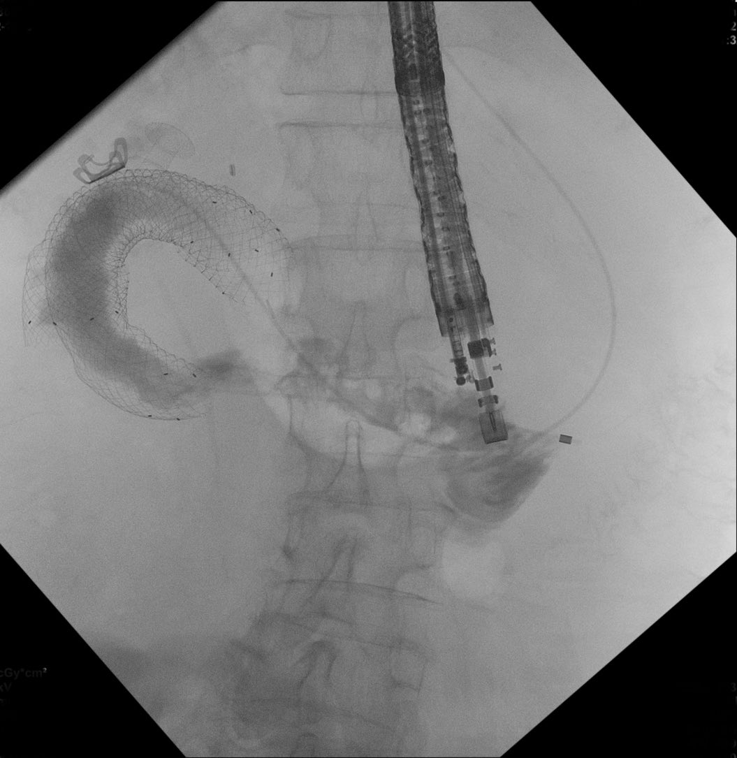 AymericBecq's tweet photo. A successful first EE gastrojejunostomy in pt w/ GOO @GHUMondor @bostonsci #endoscopy #GITwitter Patience and Glucagon are key 😅 https://t.co/yHx7F0hI0V