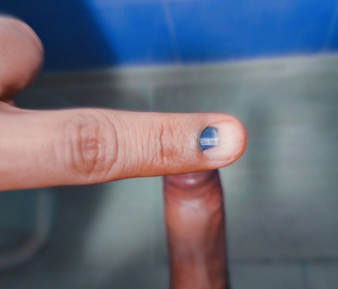 Ya ser&aacute; casi un mes que me machuque el dedo en mi trabajo y mi u&ntilde;a sigue as&iacute; 🥺🥺 creen que se caiga?😪😪<a href="/tag/lunesdemorboyprovocaci%C3%B3n"class="tags"><span>#lunesdemorboyprovocaci&oacute;n</span></a>