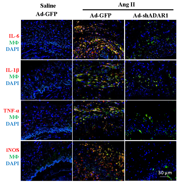 CircRes's tweet photo. In this issue of @CircRes Cai & colleagues generated a humanized #AAA model and demonstrated #ADAR1 is induced in #macrophages and contributes to AAA development. Learn more at https://t.co/kO4IQL8pYK https://t.co/xhgKXi8uHM