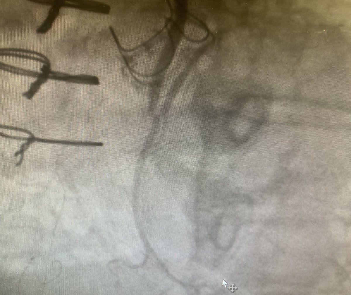 Patient from OSH w/ prior Perimount Magna savr and SVG-LAD graft due to LM impingement by valve, coming in w/ NSTEMI. Not a redo surgical candidate. What’s your approach? <a href="/WKayaniMD/">Waleed Kayani</a> <a href="/BaylorCardio/">Mahboob Alam</a> <a href="/mmamas1973/">Mamas A. Mamas</a> <a href="/ShariqShamimMD/">Dr Shariq Shamim</a> <a href="/mirvatalasnag/">MIЯVΛƬ #IC ༄ ｡°</a> <a href="/BaoGTran/">Bao Tran, MD</a> <a href="/agtruesdell/">Alex Truesdell</a> <a href="/mandeep_mayo/">mandeep singh</a>