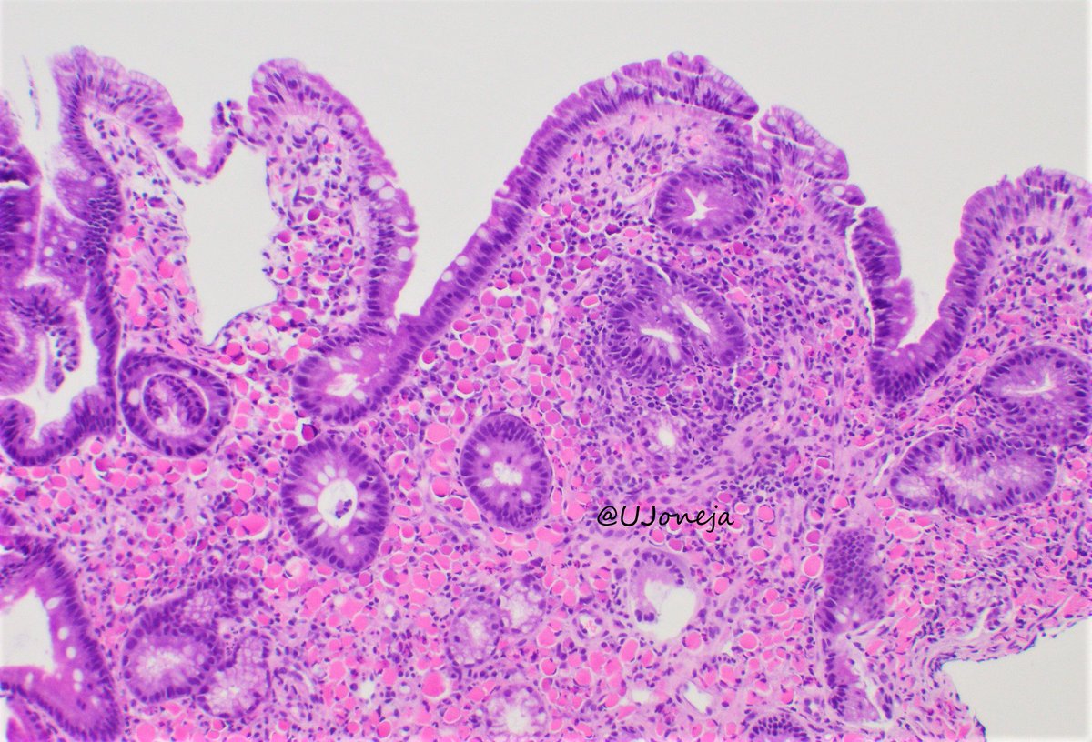 UJoneja's tweet photo. RUSSELL BODY DUODENITIS
- Less commonly seen than russell body gastritis
- Disturbed secretion of immunoglobulins that accumulate within plasma cells
- Can be seen in association with H. pylori infection and/or hematopoeitic malignancy
#pathology #PathTwitter https://t.co/LK97X7uGKQ