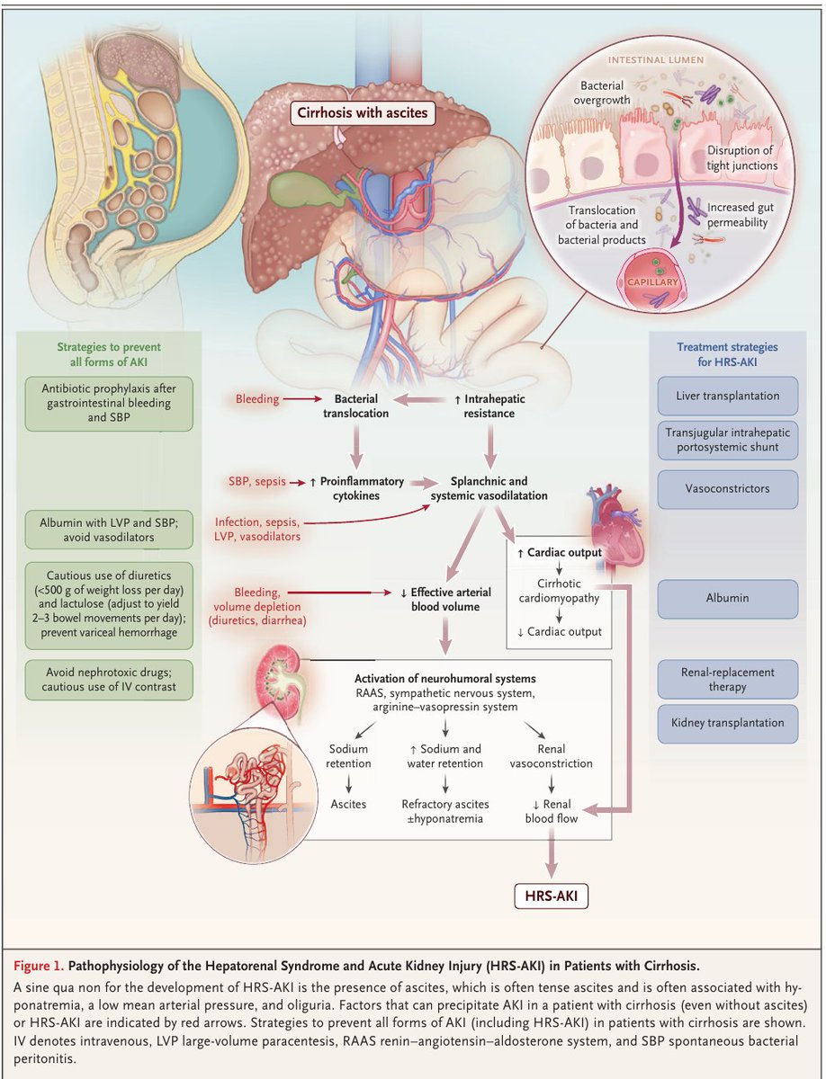 MHcsba's tweet photo. New England Journal of Medicine (NEJM) 2023: Falla renal aguda en paciente con cirrosis
DOI: 10.1056/NEJMra2215289
#MedEd #MedTwitter https://t.co/0ugLjbgAP5