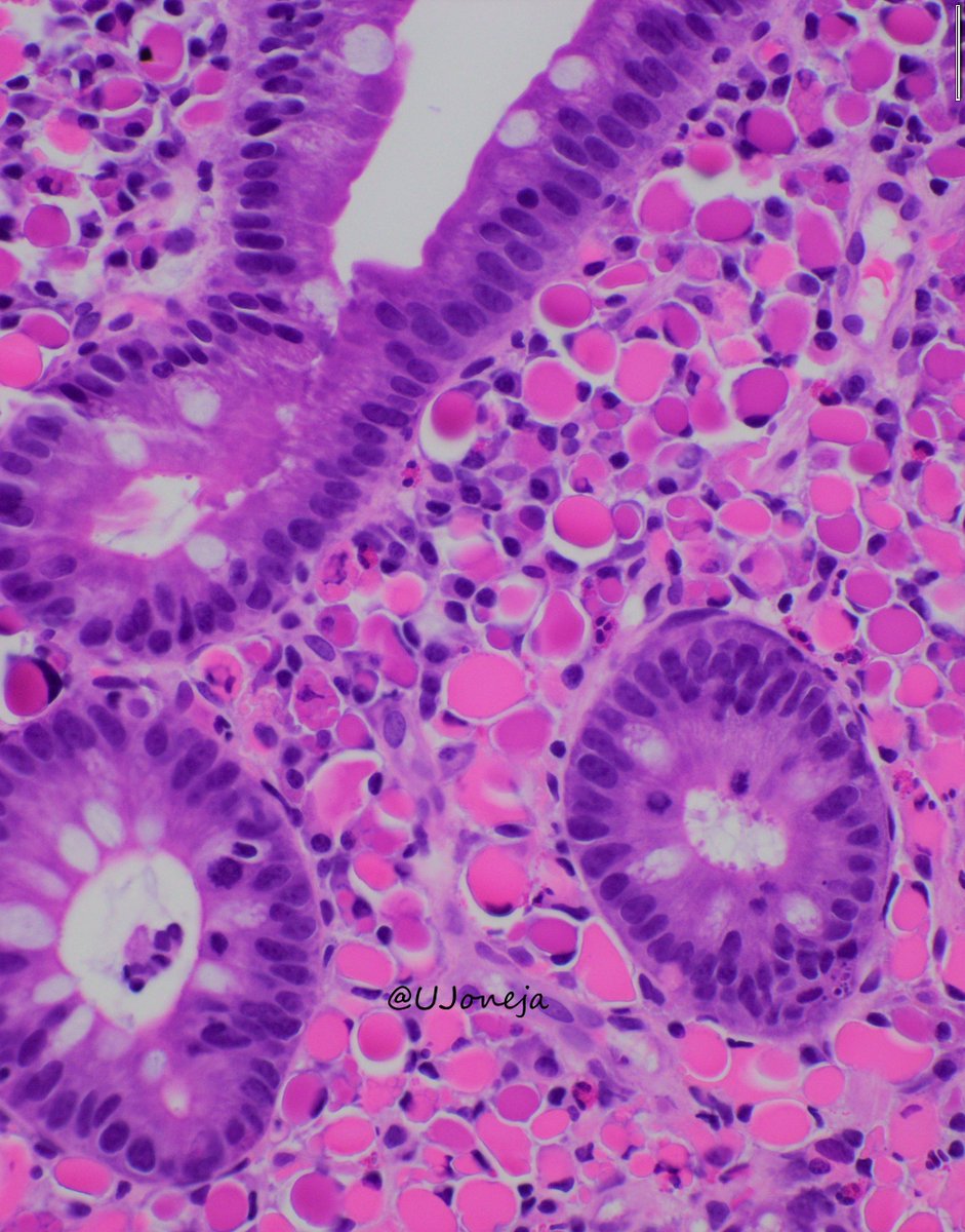 UJoneja's tweet photo. RUSSELL BODY DUODENITIS
- Less commonly seen than russell body gastritis
- Disturbed secretion of immunoglobulins that accumulate within plasma cells
- Can be seen in association with H. pylori infection and/or hematopoeitic malignancy
#pathology #PathTwitter https://t.co/LK97X7uGKQ