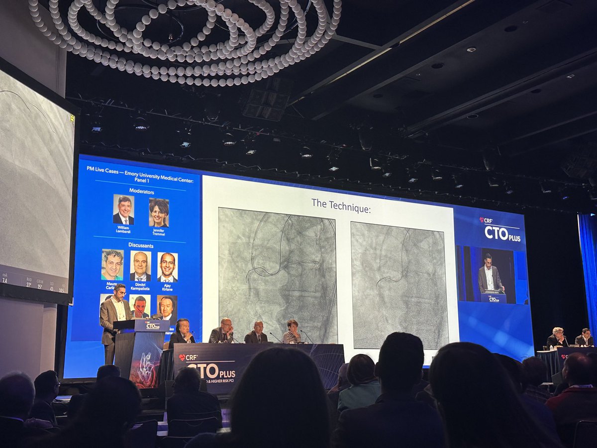 Kate Kearney (@katekearney4) on Twitter photo Don't forget CART! <a href="/thinkmdkane/">Jesse Kane, MD</a> showing us how it's done. Taking a balloon Retrograde when R-CART is unfriendly is not as bad of an idea as it sounds 😬 #CTO2023 @cardiofrizz <a href="/DrBillLombardi/">Dr. Bill Lombardi</a> <a href="/JTiwanaMD/">Jasleen Tiwana</a> <a href="/LAzzaliniMD/">Lorenzo Azzalini</a> Don't forget CART! <a href="/thinkmdkane/">Jesse Kane, MD</a> showing us how it's done. Taking a balloon Retrograde when R-CART is unfriendly is not as bad of an idea as it sounds 😬 #CTO2023 @cardiofrizz <a href="/DrBillLombardi/">Dr. Bill Lombardi</a> <a href="/JTiwanaMD/">Jasleen Tiwana</a> <a href="/LAzzaliniMD/">Lorenzo Azzalini</a>