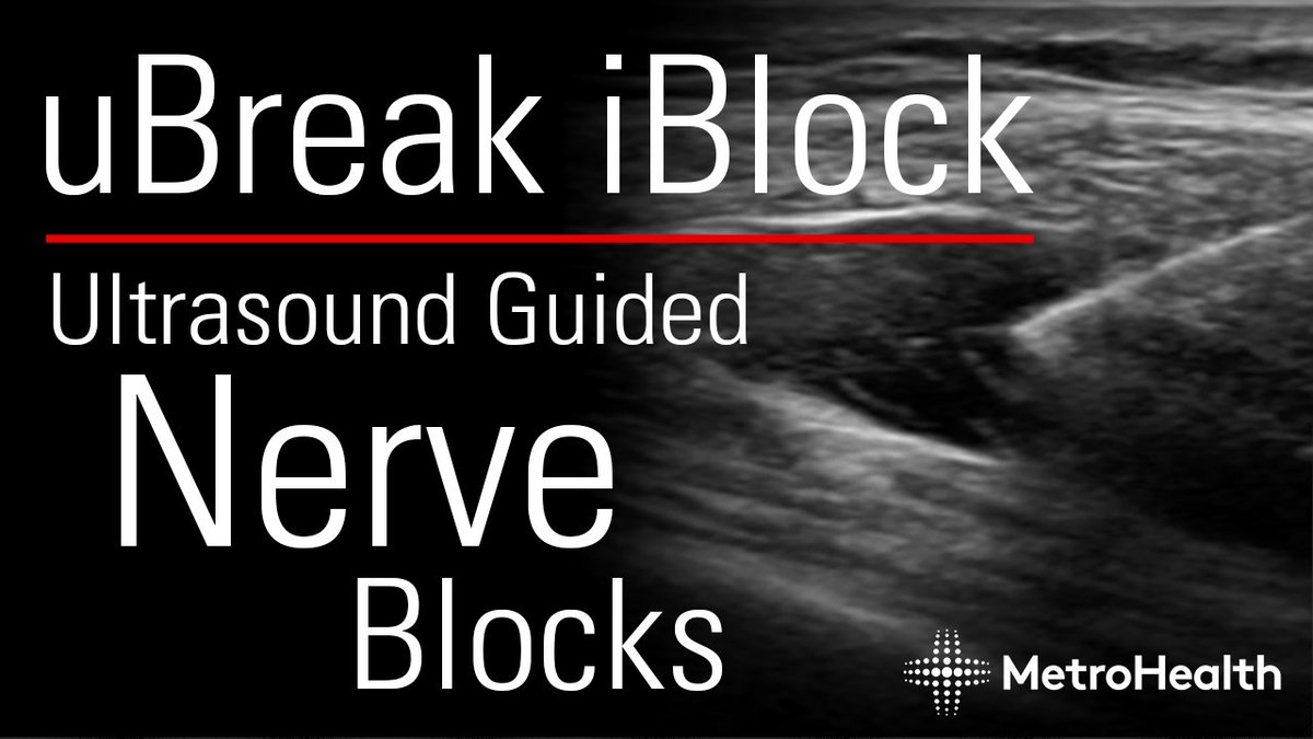 Check out our Ultrasound Grand Rounds video by @KCaja_24 about Ultrasound Guided Nerve Blocks.

youtu.be/EKbtDrlWArI

#MetroEUS #POCUS #ultrasound #Trauma #NerveBlocks