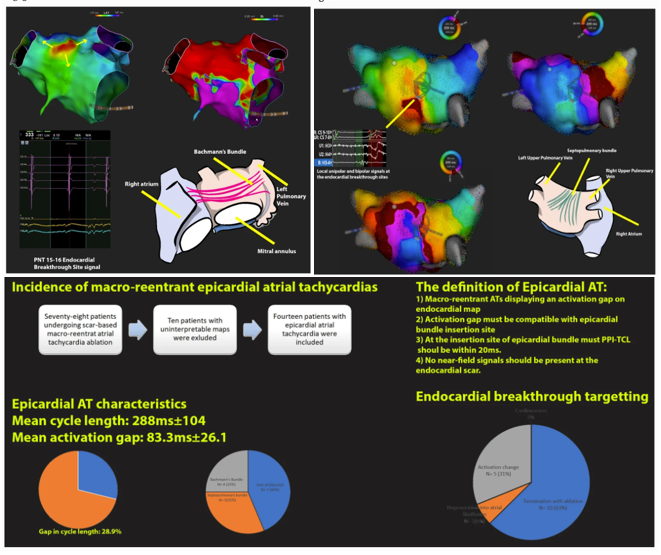🚨New #FreeRead Article in
<a href="/JICE_EP/">JICE</a>

Electrophysiological Characteristics of Epicardial Atrial Tachycardias &amp; Endocardial Breakthrough Site Targeting for Ablation: a Single Center Experience

by <a href="/baskovski/">Emir Baskovski</a> <a href="/akyurek_omer/">omer akyurek,MD</a> <a href="/Drersoy84/">İbrahim Ersoy</a> &amp; E Tutar 

🧐📖 rdcu.be/c6fUO

#EPeeps