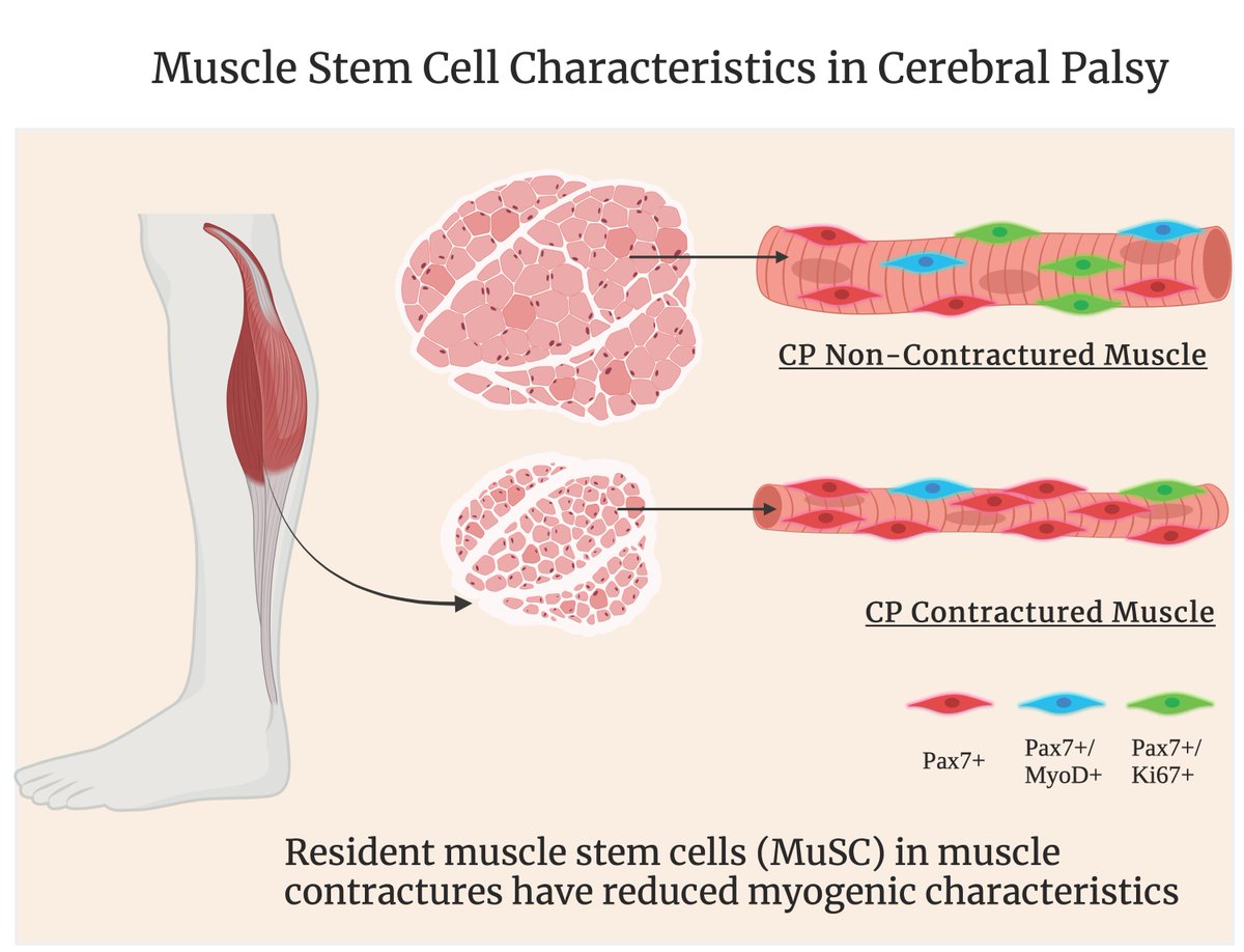 Resident #muscle stem myogenic characteristics in postnatal muscle growth impairments in children with #CerebralPalsy –

ow.ly/SpV450MZYSz

By <a href="/sududay78/">Sudarshan Dayanidhi</a> and coauthors from <a href="/AbilityLab/">Shirley Ryan AbilityLab</a>, <a href="/LurieChildrens/">Lurie Children's</a>, and <a href="/NUFeinbergMed/">Northwestern Feinberg School of Medicine</a> 

#myotwitter #ArticlesInPress #ResearchArticle
