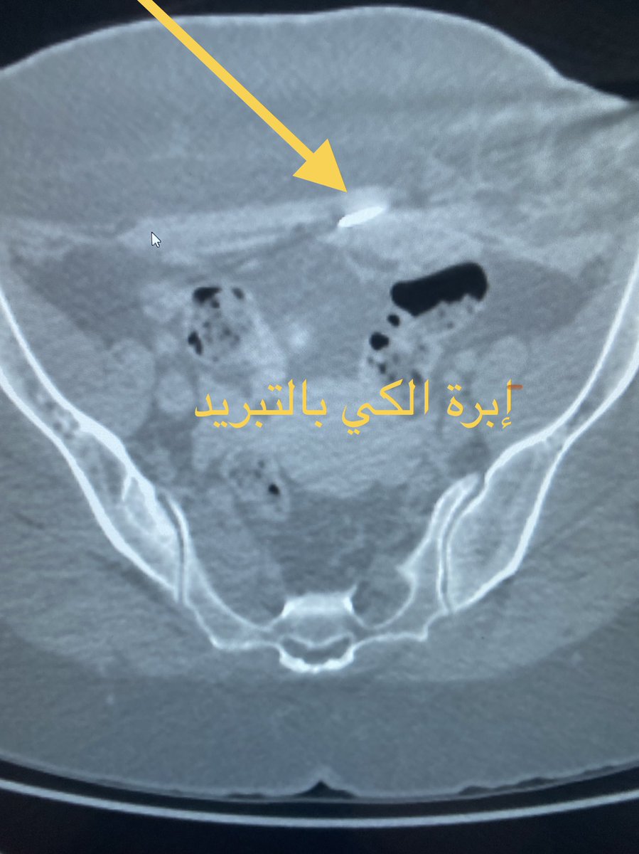 MadkhaliDr's tweet photo. فتاة ٢٨ سنه تعاني من ألم مكان جرح العملية القيصرية مع كل دورة. تم تشخيصها بالرنين المغناطيسي بطانة رحم مزروعة في جدار البطن تتأثر بهرمونات الدورة. تم علاجها بفضل الله بالتبريد بواسطة إبرة بالأشعة التداخلية. الأعراض اختفت تماما دون اي اثر . الحمدلله @shaker_rad https://t.co/U6Sy1HZkGE