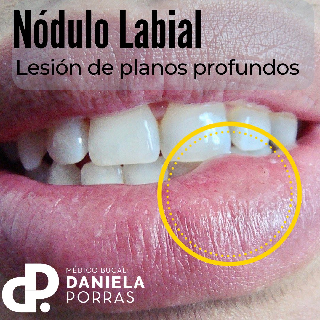 dradanielapg's tweet photo. Los nódulos son un tipo de lesión elemental que describe las patologías que provienen de los planos profundos de la mucosa bucal. Tal como lo vemos en esta fotografía ⤵️⤵️⤵️ https://t.co/aTvVk8ssld