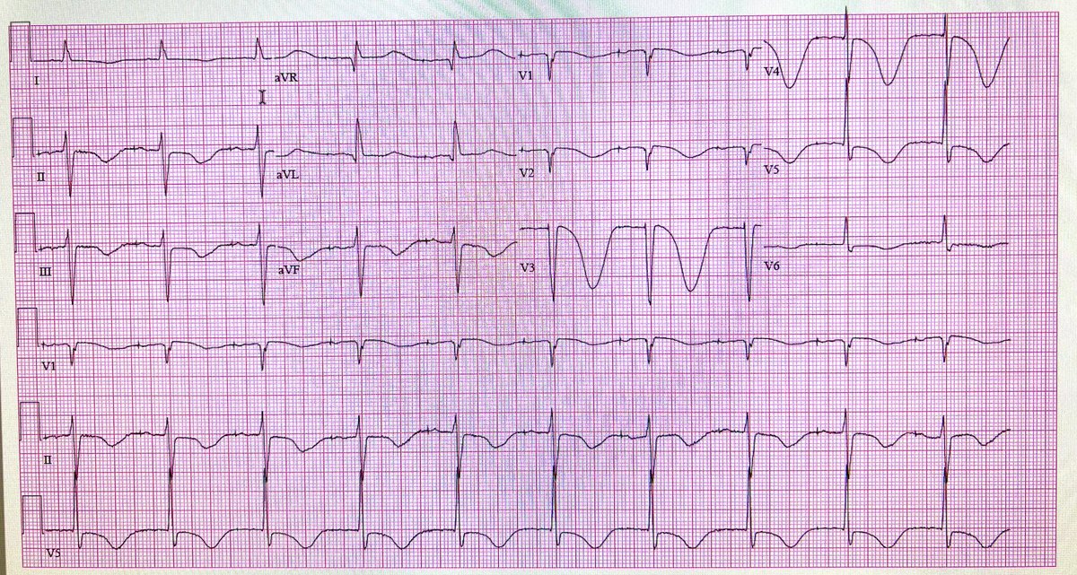 Toaster_Pastry's tweet photo. About 4 hours after a cardioversion for atrial fibrillation, I got this ECG. I still haven’t figured out why. https://t.co/0kZQkj6213