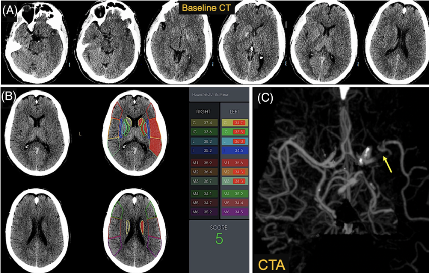 Great discussions about the future of  stroke interventions with @SNISinfo webinar today. @JMoccoMD @dr_mchen @SunilAShethMD @MajidiShahram @StavTjoumakaris 
We and others have shown that even non-contrast CT 'strokes' are reversible with reperfusion. 
ahajournals.org/doi/full/10.11…