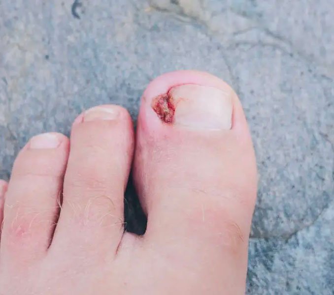 What should you do with an infected ingrown toenail? Read when to see a podiatrist and other tips for preventing and treating ingrown toenails: bit.ly/3SrHRLo

#ingrowntoenail #toenails #toenailcare #podiatrist #UFAI #footandanklespecialists #santamonica #loaangeles