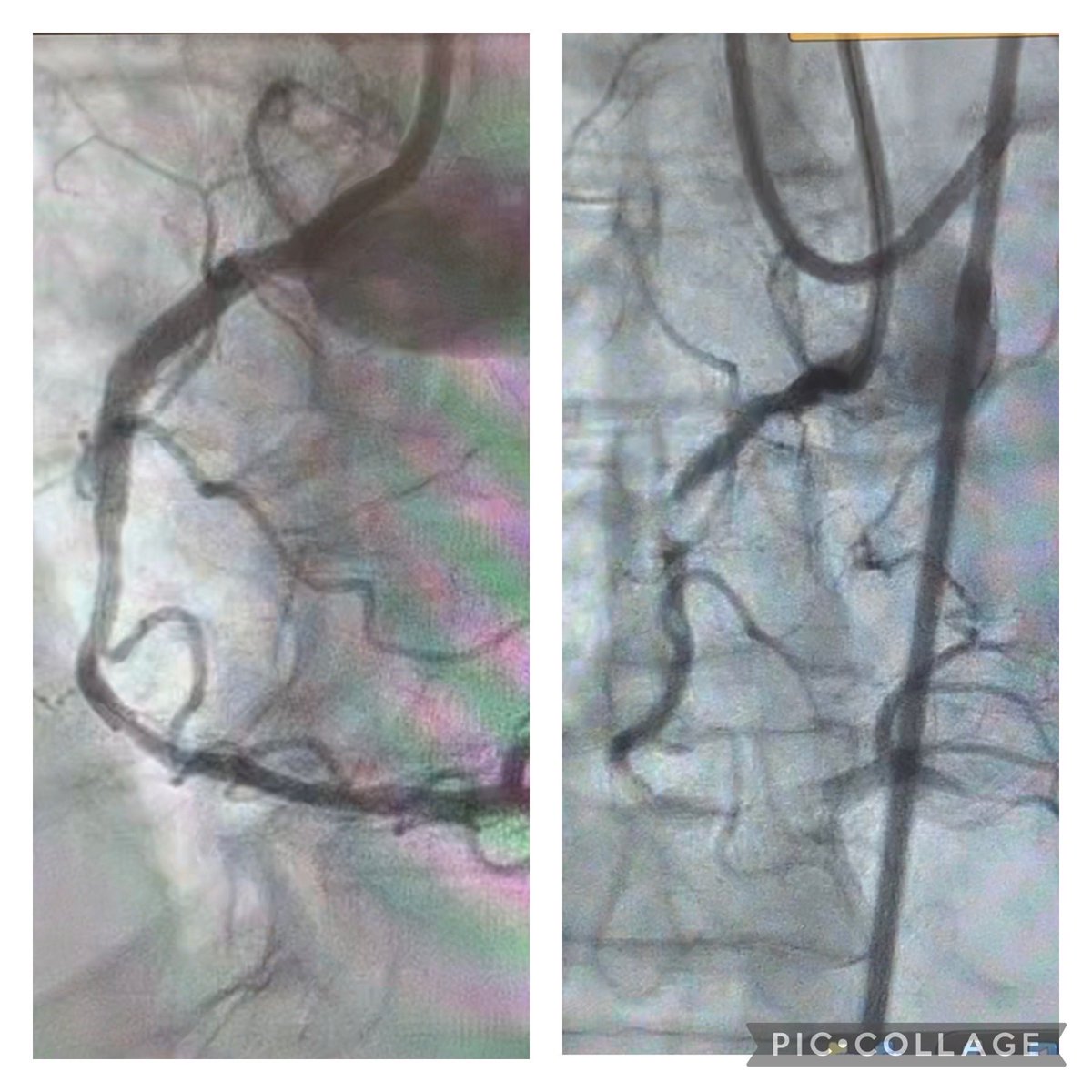 Maybe not CTO by definition- but calcific nodule treated with Atherectomy- live case #CTOPLUS with ⁦@RinfretStephane⁩ ⁦@RhianEDavies1⁩⁦@wjn_md⁩ ⁦@DrDarshanDoshi⁩ ⁦@perc_surgeon⁩ ⁦@ajaykirtane⁩ ⁦@mbmcentegart⁩ ⁦@AnjaKsnes⁩