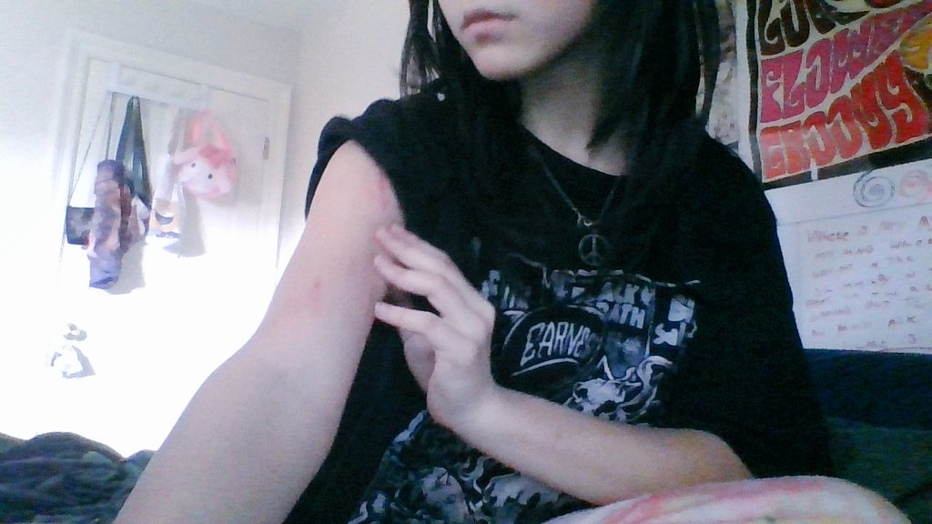 fayeplastictree's tweet photo. do u guys have any tips on how to get rid of Hickey's or hide them im kinda screwd https://t.co/PO5QdHQnva