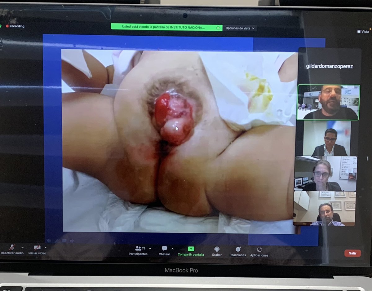 Agradecemos a todos aquellos que están conectados a nuestro evento académico de hoy!!! EXTROFIA VESICAL!!! Excelente concurrencia con casi 80 personas en la sala de zoom!!! #siupchile2033