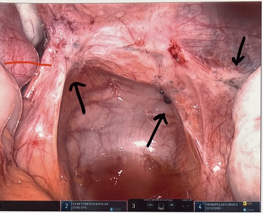 AakritiCarrubba's tweet photo. Normal first glance at the pelvis.. but when you look closer, the endometriosis is evident. 

#EndometriosisAwareness #excisionsurgery 🎗️#MIGS #chronicpelvicpain https://t.co/NC2p51zjdq