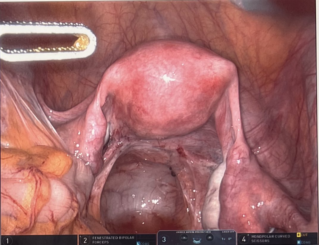 AakritiCarrubba's tweet photo. Normal first glance at the pelvis.. but when you look closer, the endometriosis is evident. 

#EndometriosisAwareness #excisionsurgery 🎗️#MIGS #chronicpelvicpain https://t.co/NC2p51zjdq