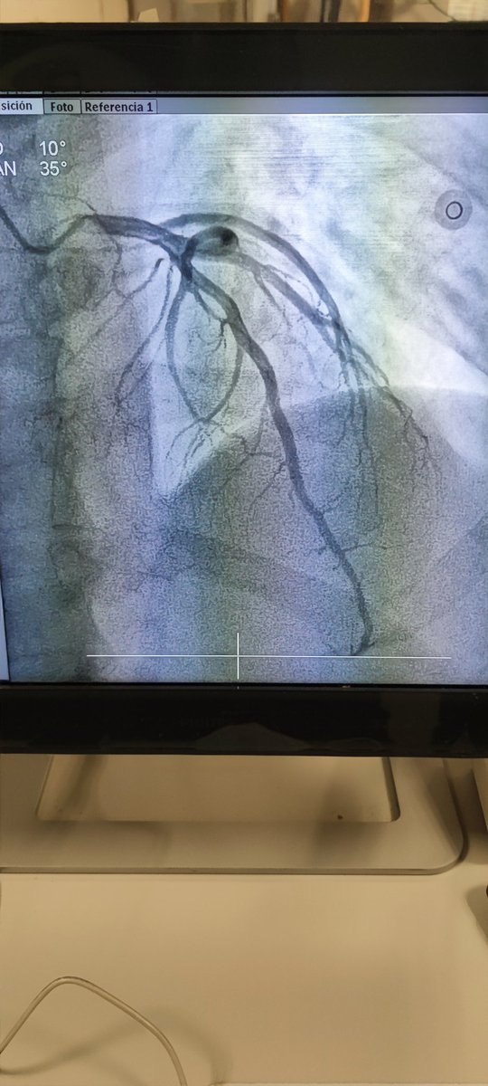 Abcsm74's tweet image. 🫀⚡🧔🏻 45a, 🚬intenso, sedentario, obeso, HTA, #SICA #RadialFirst angio CD OTC agudizada TM disección ostial, Fullmetal CD 👌🏼 #MasterTheComplex #PCI #IVUS #Terumo #Azahi #BostonScientific #Medtronic
