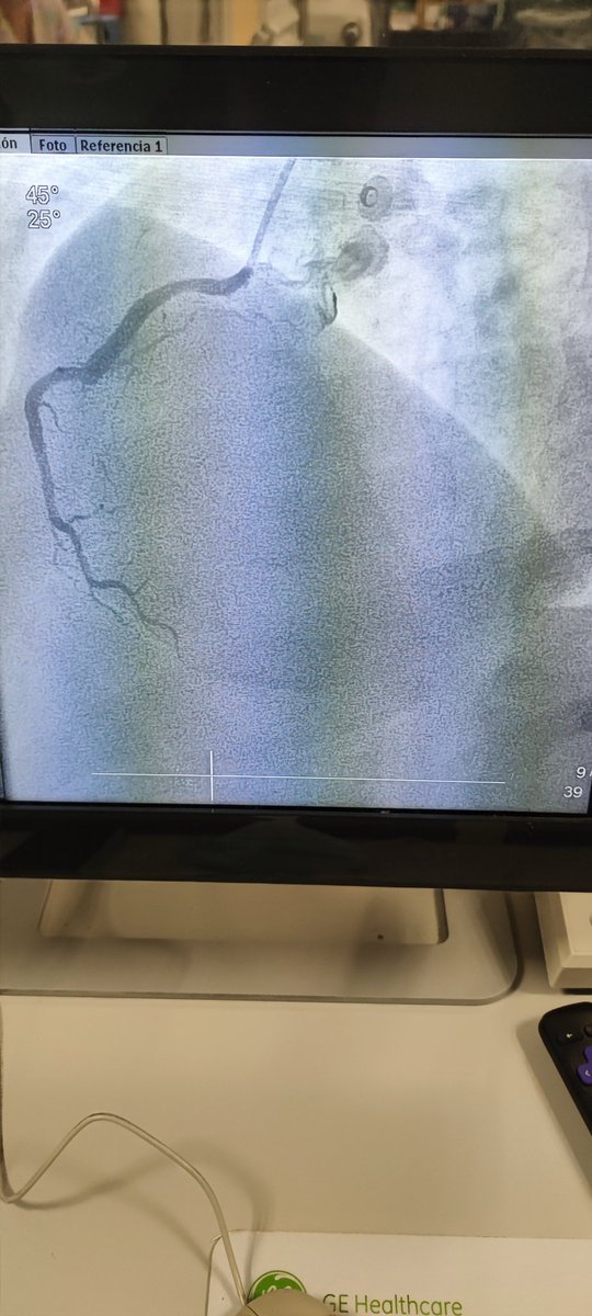 Abcsm74's tweet image. 🫀⚡🧔🏻 45a, 🚬intenso, sedentario, obeso, HTA, #SICA #RadialFirst angio CD OTC agudizada TM disección ostial, Fullmetal CD 👌🏼 #MasterTheComplex #PCI #IVUS #Terumo #Azahi #BostonScientific #Medtronic