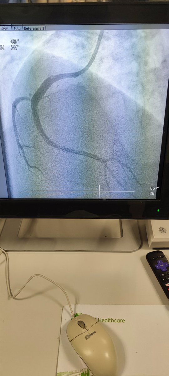 Abcsm74's tweet image. 🫀⚡🧔🏻 45a, 🚬intenso, sedentario, obeso, HTA, #SICA #RadialFirst angio CD OTC agudizada TM disección ostial, Fullmetal CD 👌🏼 #MasterTheComplex #PCI #IVUS #Terumo #Azahi #BostonScientific #Medtronic