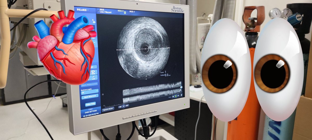 Abcsm74's tweet image. 🫀⚡🧔🏻 45a, 🚬intenso, sedentario, obeso, HTA, #SICA #RadialFirst angio CD OTC agudizada TM disección ostial, Fullmetal CD 👌🏼 #MasterTheComplex #PCI #IVUS #Terumo #Azahi #BostonScientific #Medtronic