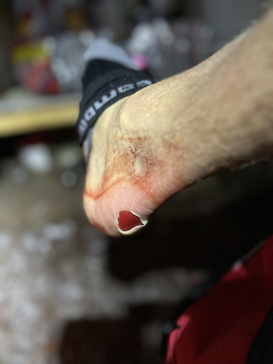 Hot or cold, blisters are always a nemesis! #arctic #baffin #cold #adventure