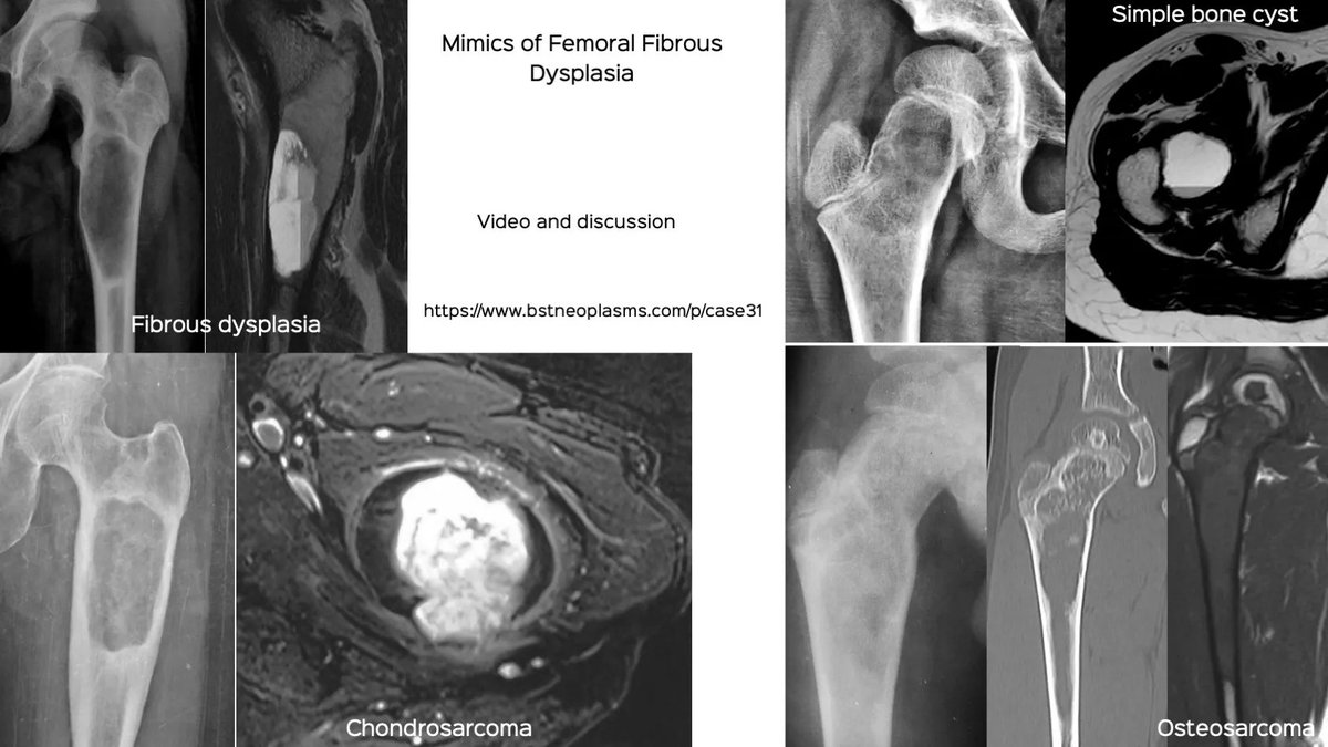 Mimics of Fibrous Dysplasia

Discussion video

bstneoplasms.com/p/case31

#bstneoplasms #bonetumor #radres  #femur #fibrousdysplasia