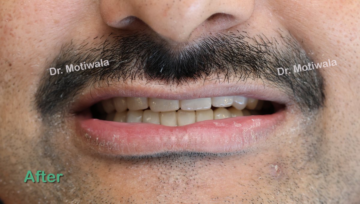 drmotiwaladcic's tweet image. Full Mouth Crowns with few dental implants in 5 days !
 
Before and after with  zirconia crowns

#zirconiacrowns #dentalimplants #fixedteeth #fullmouth #basalimplants #Hyderabad #India #newsmile #dentistry #cosmeticdentistry

drmotiwala.com/is-zirconia-cr…