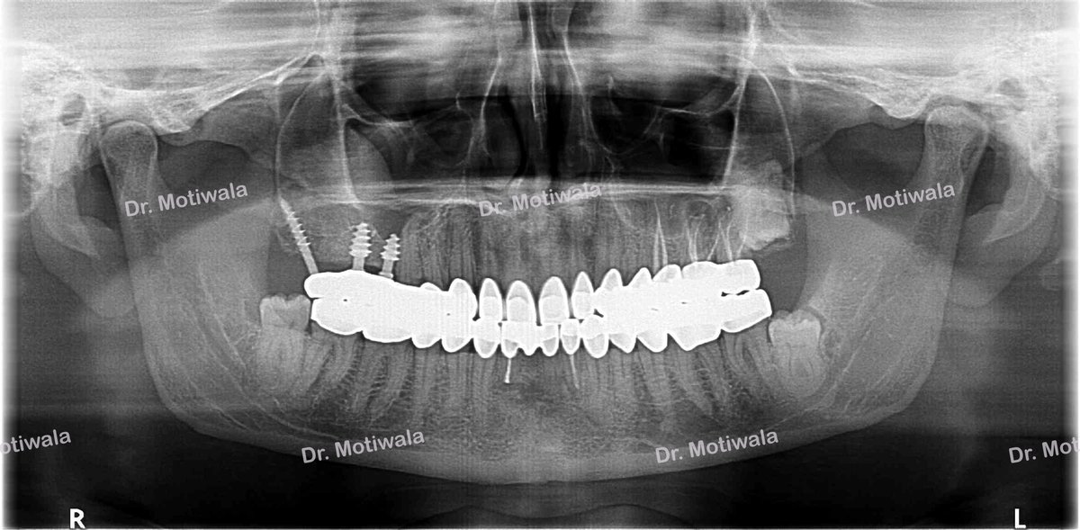 drmotiwaladcic's tweet image. Full Mouth Crowns with few dental implants in 5 days !
 
Before and after with  zirconia crowns

#zirconiacrowns #dentalimplants #fixedteeth #fullmouth #basalimplants #Hyderabad #India #newsmile #dentistry #cosmeticdentistry

drmotiwala.com/is-zirconia-cr…