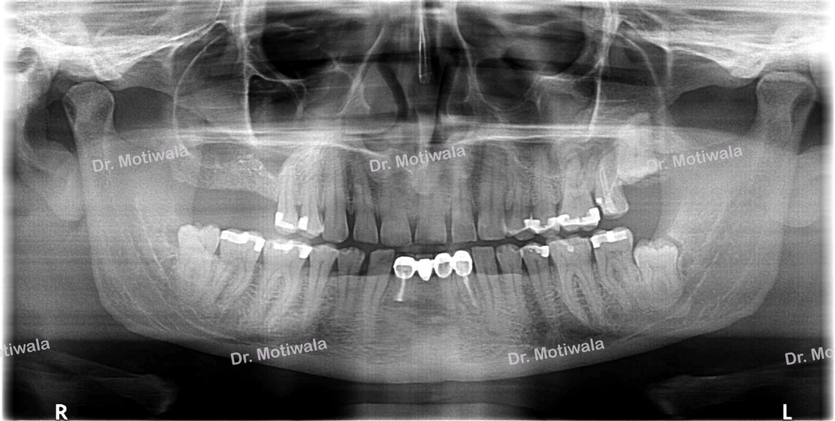 drmotiwaladcic's tweet image. Full Mouth Crowns with few dental implants in 5 days !
 
Before and after with  zirconia crowns

#zirconiacrowns #dentalimplants #fixedteeth #fullmouth #basalimplants #Hyderabad #India #newsmile #dentistry #cosmeticdentistry

drmotiwala.com/is-zirconia-cr…