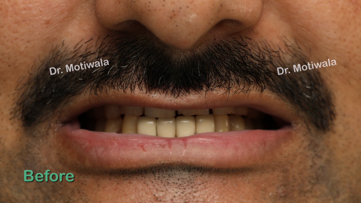drmotiwaladcic's tweet image. Full Mouth Crowns with few dental implants in 5 days !
 
Before and after with  zirconia crowns

#zirconiacrowns #dentalimplants #fixedteeth #fullmouth #basalimplants #Hyderabad #India #newsmile #dentistry #cosmeticdentistry

drmotiwala.com/is-zirconia-cr…
