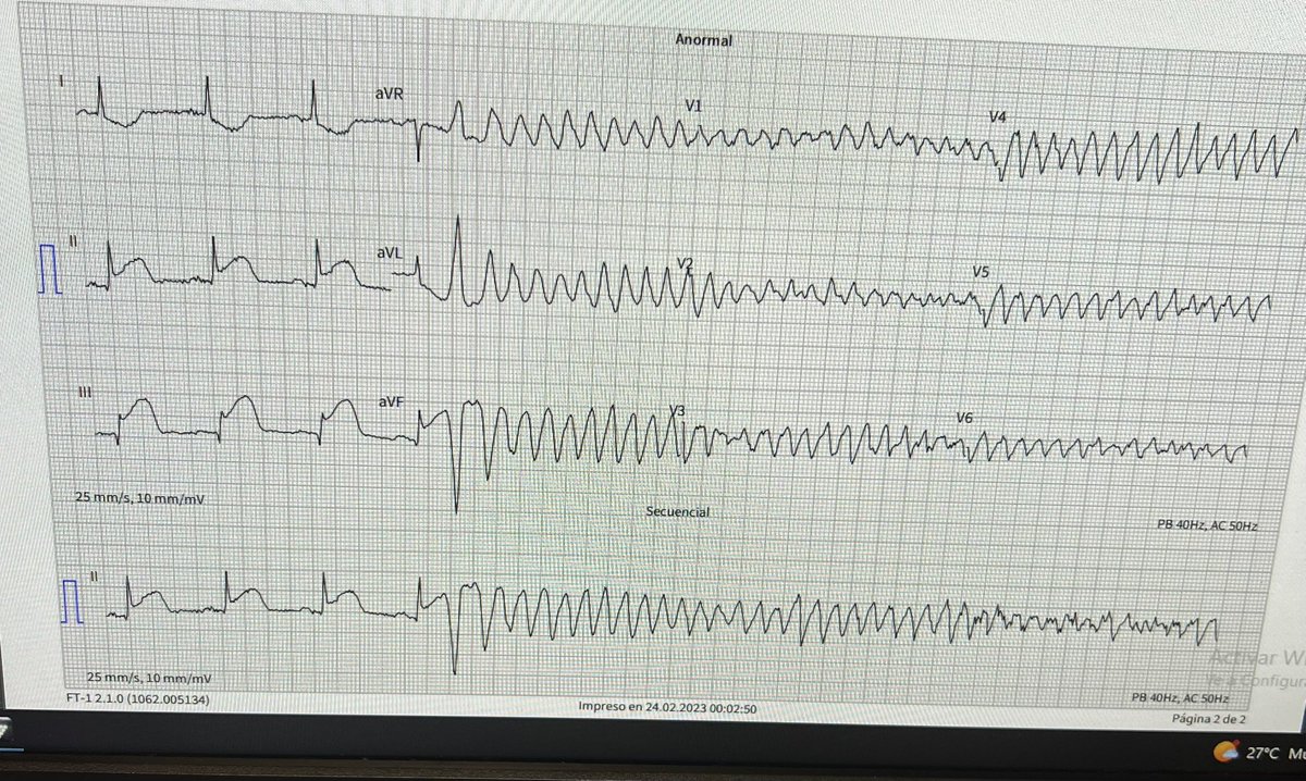👩 63a, consulta por dolor precordial típico en CF IV.

Al ingreso intercurre con deterioro del sensorio y PCR con el siguiente ECG 😧 ⚡️ 

¿Que vemos?
¿Cual es la conducta?