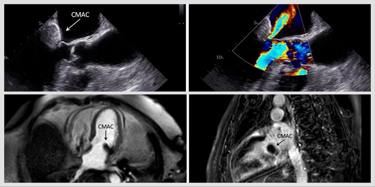 Baravan Al-Kassou | MD (@bara_doc) on Twitter photo ⚡️Thrombotic #STEMI caused by a caseous mitral annular calcification⚡️
Happy to share our latest #CaseReport and short #Review on #CMAC published in Clinical Research in Cardiology:
link.springer.com/article/10.100…… <a href="/Seb_Zimmer_/">Sebastian Zimmer</a>
Any #experience with similar cases? ⚡️Thrombotic #STEMI caused by a caseous mitral annular calcification⚡️
Happy to share our latest #CaseReport and short #Review on #CMAC published in Clinical Research in Cardiology:
link.springer.com/article/10.100…… <a href="/Seb_Zimmer_/">Sebastian Zimmer</a>
Any #experience with similar cases?