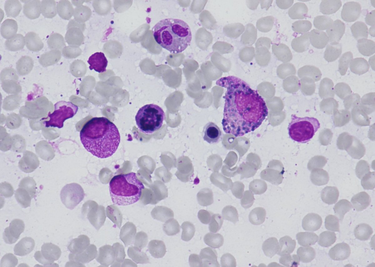 Promyelocyte13's tweet photo. No #bitesizemorphology today as I'm presenting a lunchtime seminar across our #NMCPS path network instead. Presenting 5 cases of #dualpathology & discussing the co-occurrence of Myeloid and Lymphoid Malignancy @UHNM_NHS #haematology #morphology #education #training π¬π©βπ¬ https://t.co/b0USQq3BhW