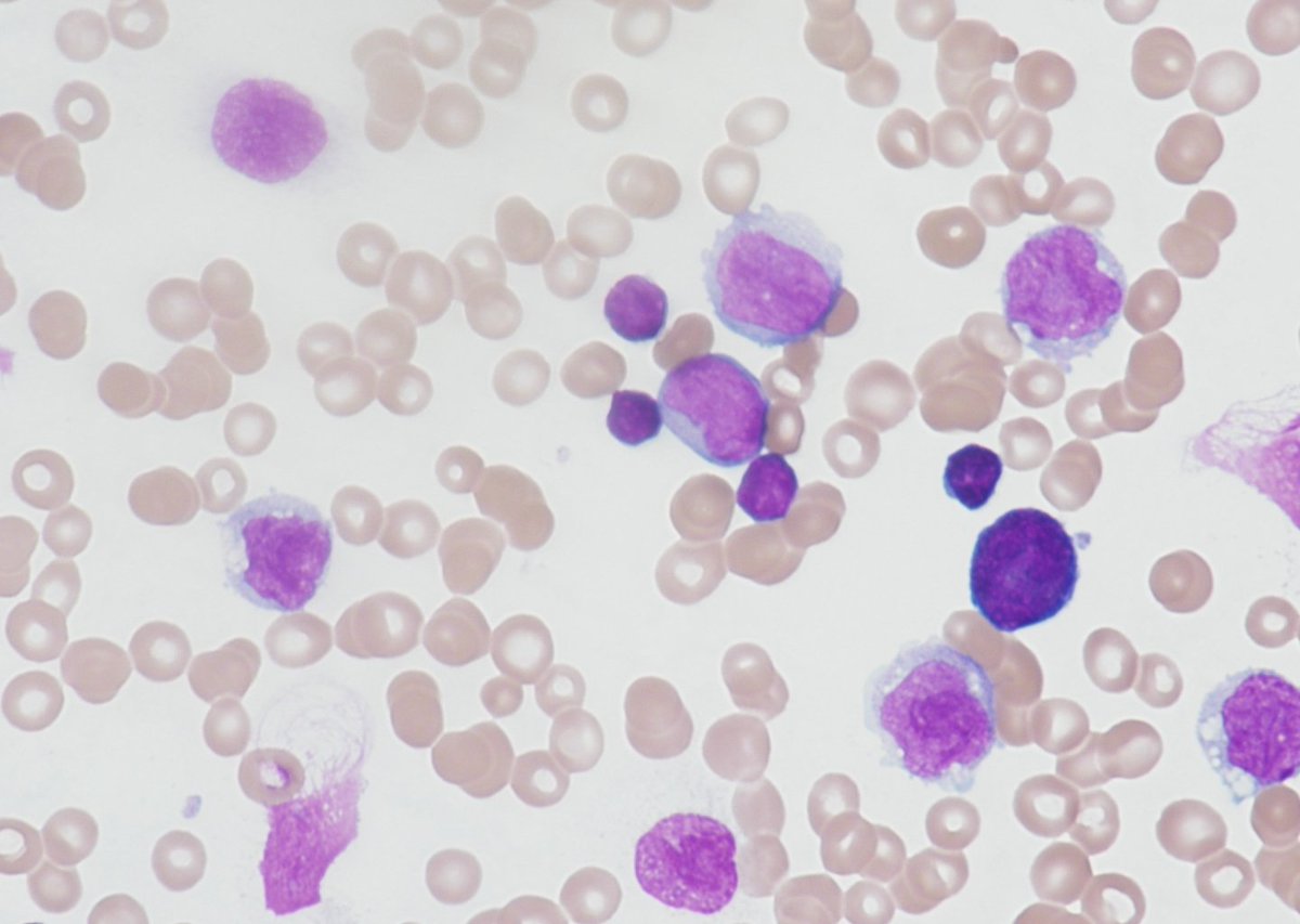 Promyelocyte13's tweet photo. No #bitesizemorphology today as I'm presenting a lunchtime seminar across our #NMCPS path network instead. Presenting 5 cases of #dualpathology & discussing the co-occurrence of Myeloid and Lymphoid Malignancy @UHNM_NHS #haematology #morphology #education #training π¬π©βπ¬ https://t.co/b0USQq3BhW