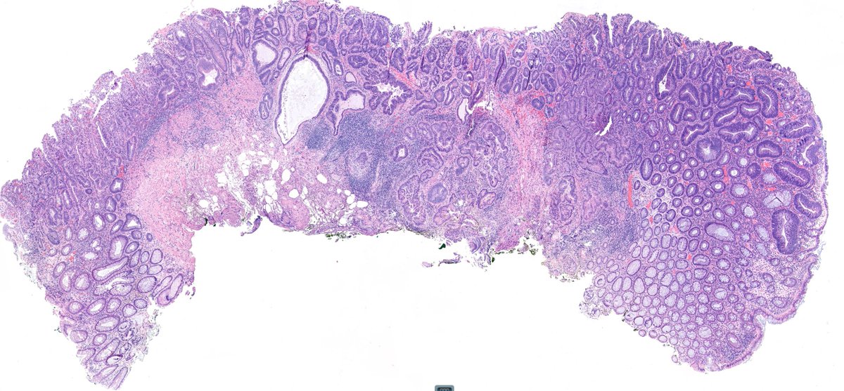 zucchiatti_'s tweet image. Rectal polyp. Pseudoinvasion or a pT1?

A case of epithelial displacement vs pT1, before #GIpath short course at #USCAP23

What do you think?🤔