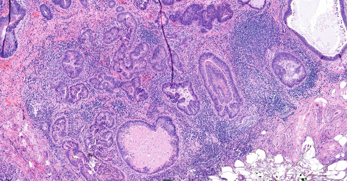 zucchiatti_'s tweet image. Rectal polyp. Pseudoinvasion or a pT1?

A case of epithelial displacement vs pT1, before #GIpath short course at #USCAP23

What do you think?🤔