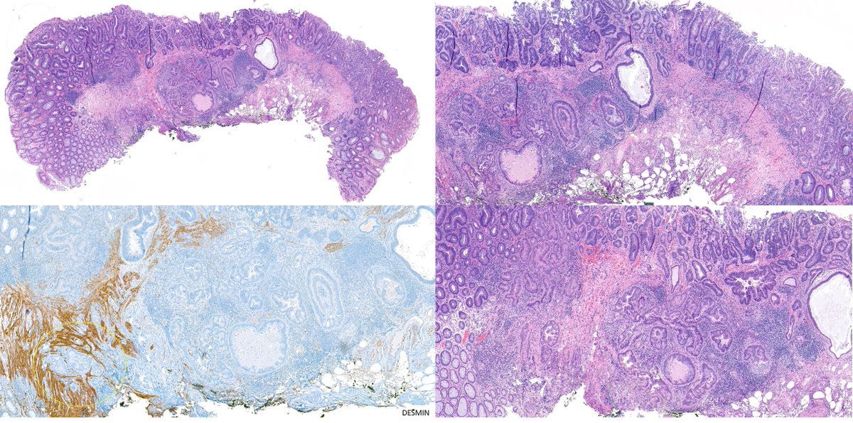 zucchiatti_'s tweet image. Rectal polyp. Pseudoinvasion or a pT1?

A case of epithelial displacement vs pT1, before #GIpath short course at #USCAP23

What do you think?🤔