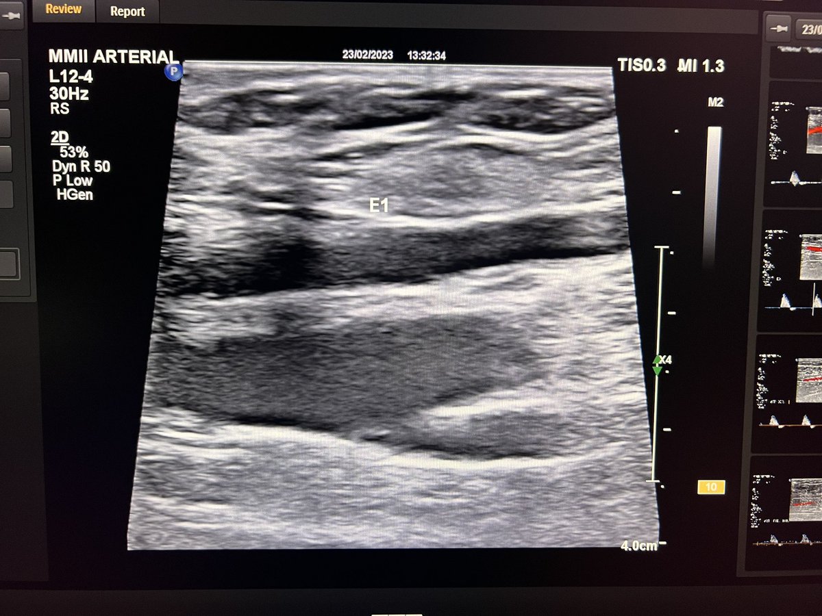 ChaconMatoso's tweet photo. post angioplasty surveillance, showing a drop in velocity from 195cm/s to 104 cm/s and in mode B, luminal narrowing was no longer observed. https://t.co/WwUxmo64D9