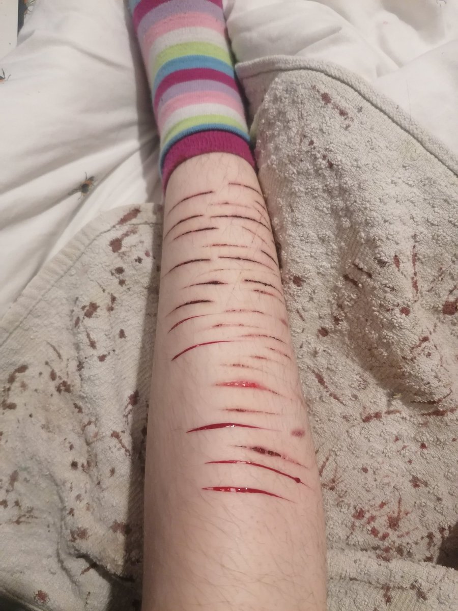 ab128974's tweet photo. tw sh//
SFX makeup special effects whoo
*
*
*
*
*
*
I ran out of room on my arms so my funny little brain decided whats the leg equivalent of an arm so in the past 2 weeks my calf has gone from barely scarred to a 13 year olds arm and I'm honestly loving it https://t.co/cIC6gAh6la