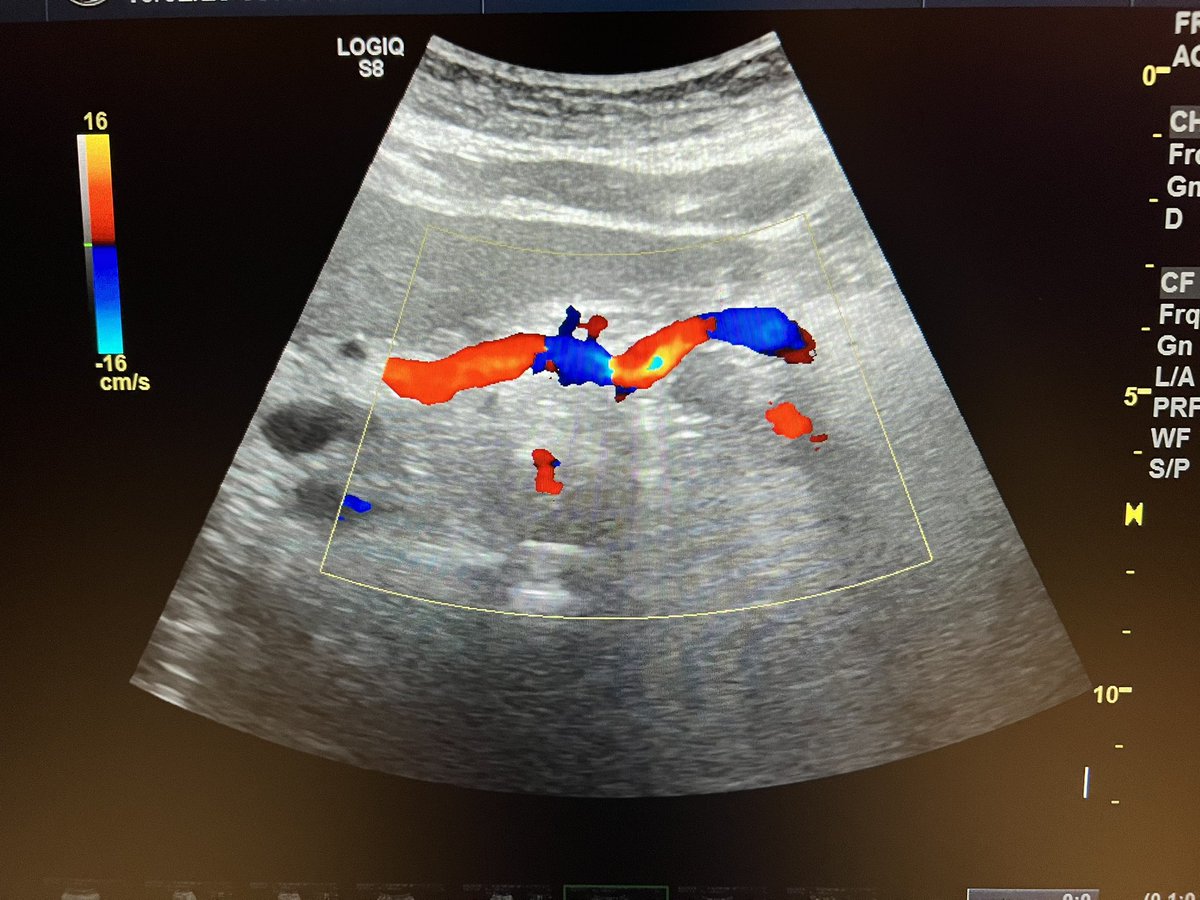 ChaconMatoso's tweet photo. the image of the seagull in the color mode of the celiac trunk is well known, but what alteration can we observe in this image?#doppler #vascular https://t.co/8esgaVpDo1