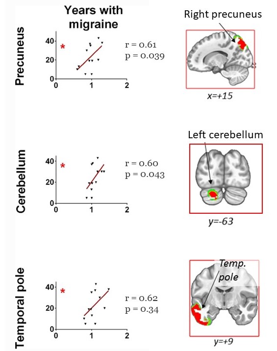 Emi1103's tweet photo. Among other results: a strong +correlation between eCSD in the right precuneus, left temporal pole, and right cerebellum and the variable ‘Years with migraine’, indicating a high level of eCSD associated with longer years of persistent migraine disease. https://t.co/TST4wYEzV8 https://t.co/Bsrbz16yzI